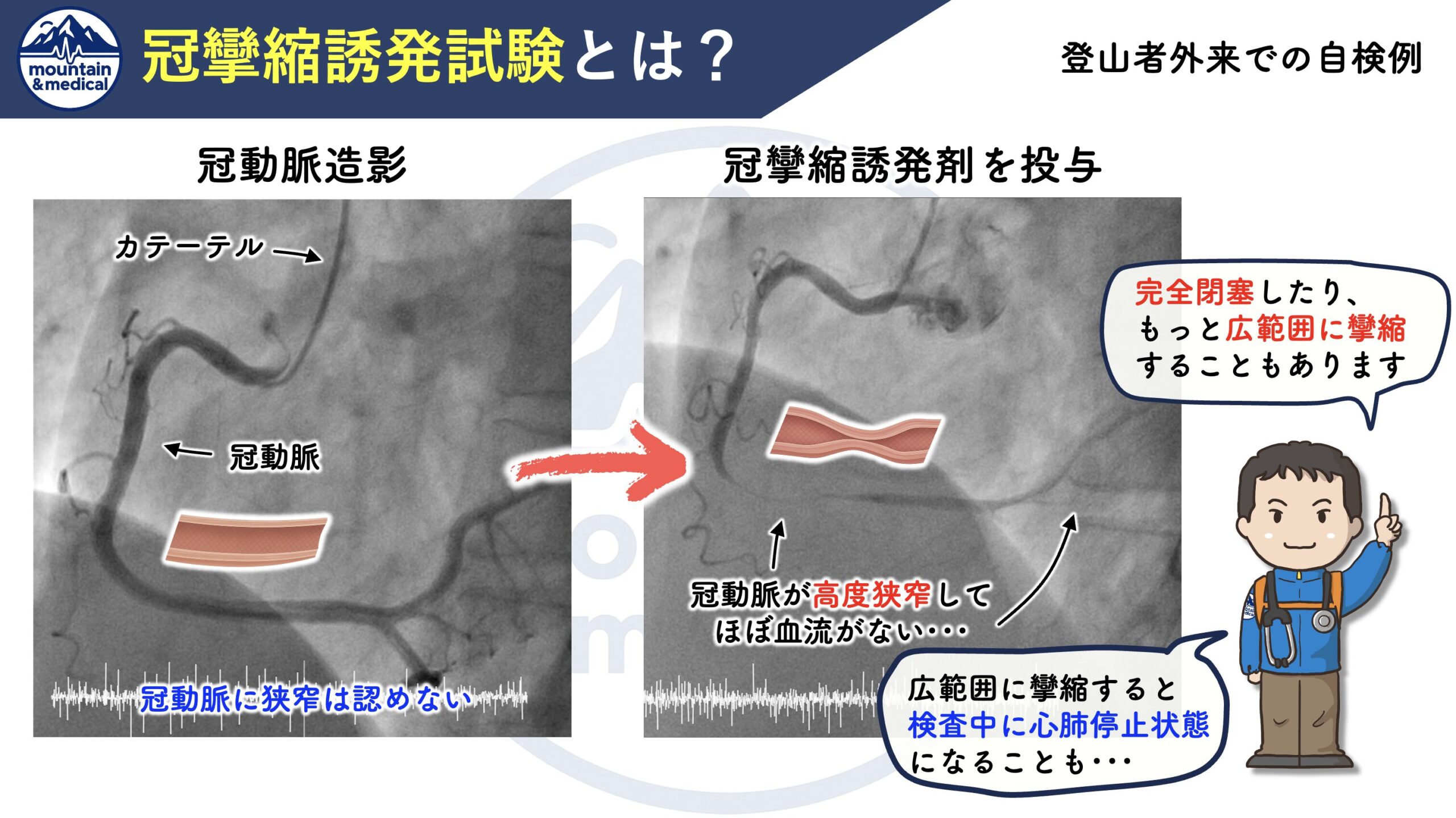 冠 攣縮 性 狭 心 症