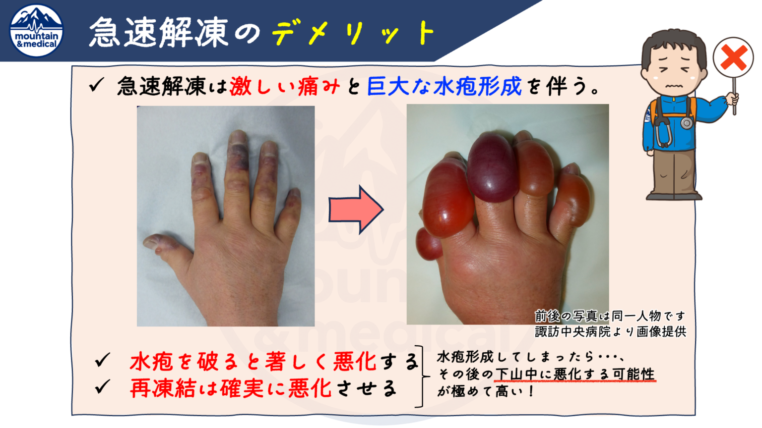 【第2回】凍傷の応急処置は温めるな!?山岳医が教える”急速解凍の危険性”と正しい初期対応 | 登山×医療ブログ