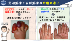 【第2回】凍傷の応急処置は温めるな!?山岳医が教える”急速解凍の危険性”と正しい初期対応 | 登山×医療ブログ