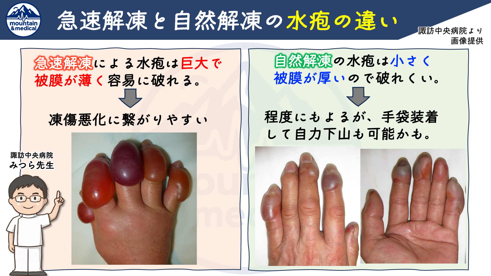 【第2回】凍傷の応急処置は温めるな!?山岳医が教える”急速解凍の危険性”と正しい初期対応 | 登山×医療ブログ