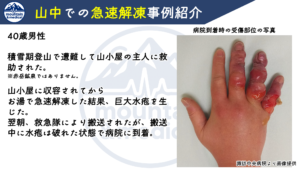 【第2回】凍傷の応急処置は温めるな!?山岳医が教える”急速解凍の危険性”と正しい初期対応 | 登山×医療ブログ